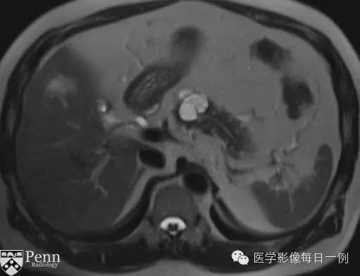 【病例】胰腺多囊浆液性囊腺瘤1例CT MR影像表现 【病例】胰腺多囊浆液性囊腺瘤1例CT MR影像表现