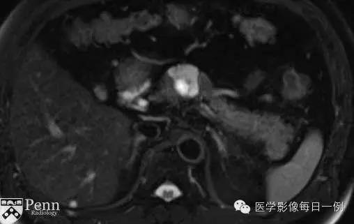 【病例】胰腺多囊浆液性囊腺瘤1例CT MR影像表现 【病例】胰腺多囊浆液性囊腺瘤1例CT MR影像表现