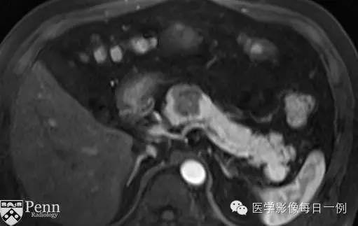 【病例】胰腺多囊浆液性囊腺瘤1例CT MR影像表现 【病例】胰腺多囊浆液性囊腺瘤1例CT MR影像表现