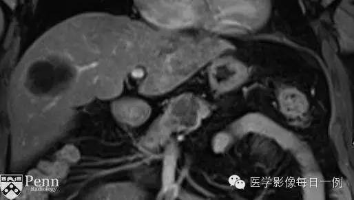 【病例】胰腺多囊浆液性囊腺瘤1例CT MR影像表现 【病例】胰腺多囊浆液性囊腺瘤1例CT MR影像表现