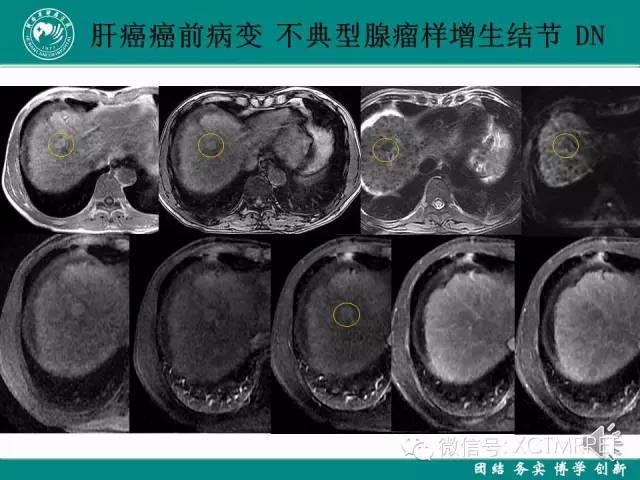 【PPT】HCC的早期诊断及CDT技术的应用