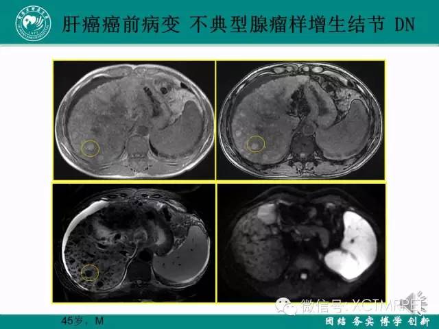 【PPT】HCC的早期诊断及CDT技术的应用