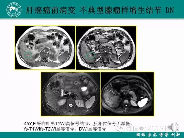 【PPT】HCC的早期诊断及CDT技术的应用