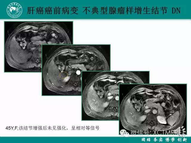 【PPT】HCC的早期诊断及CDT技术的应用