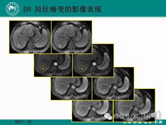 【PPT】HCC的早期诊断及CDT技术的应用