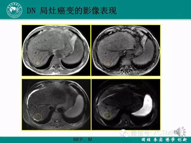【PPT】HCC的早期诊断及CDT技术的应用
