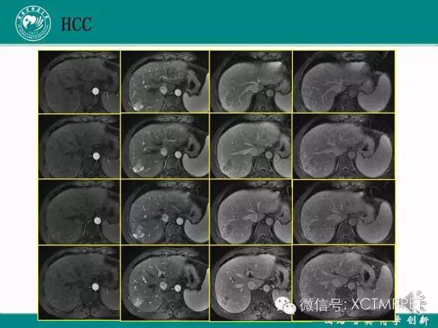 【PPT】HCC的早期诊断及CDT技术的应用