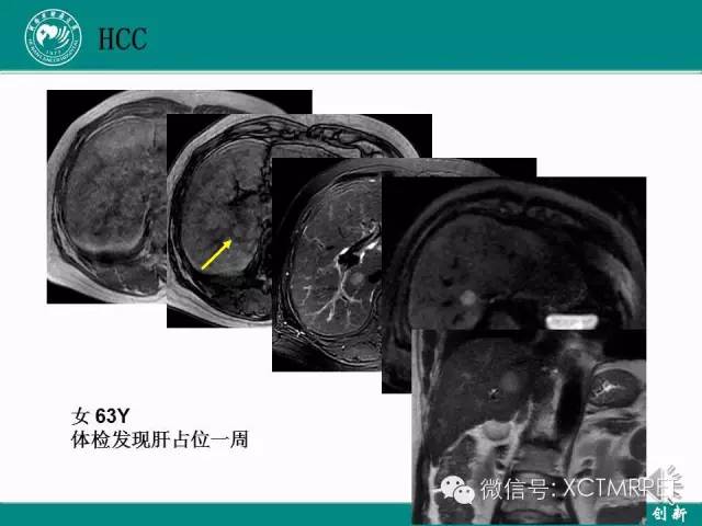 【PPT】HCC的早期诊断及CDT技术的应用