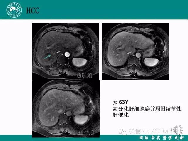 【PPT】HCC的早期诊断及CDT技术的应用