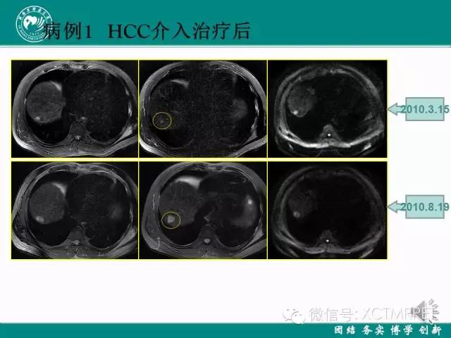 【PPT】HCC的早期诊断及CDT技术的应用