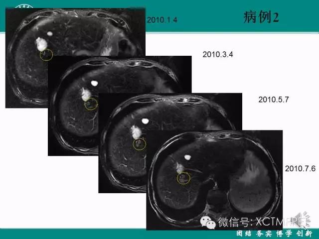 【PPT】HCC的早期诊断及CDT技术的应用
