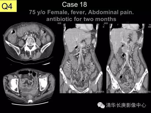 【病例】伪膜性肠炎1例CT影像表现