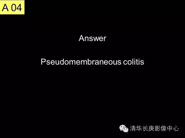【病例】伪膜性肠炎1例CT影像表现