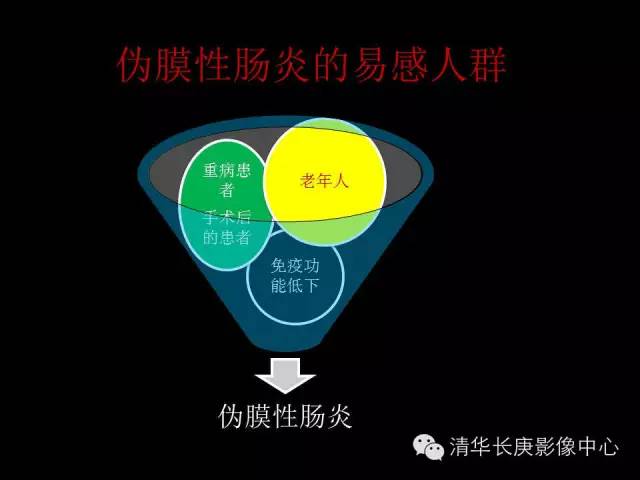 【病例】伪膜性肠炎1例CT影像表现