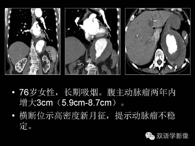 【PPT】MDCT评价腹主动脉瘤不稳定性