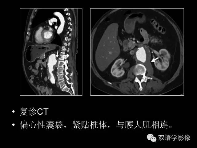 【PPT】MDCT评价腹主动脉瘤不稳定性