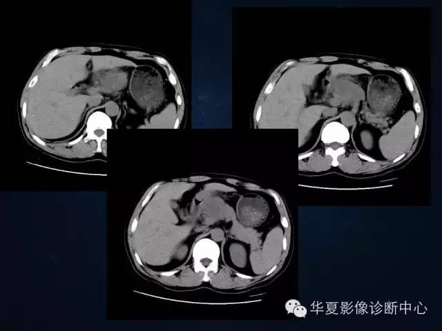 【病例】胰腺原发性恶性淋巴瘤1例CT影像表现与鉴别
