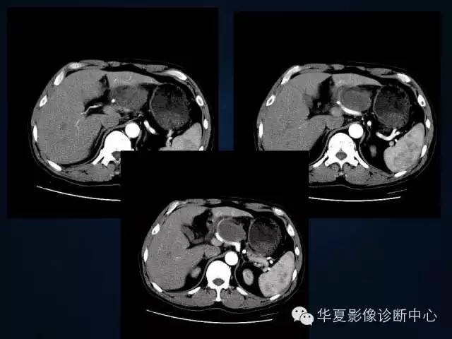 【病例】胰腺原发性恶性淋巴瘤1例CT影像表现与鉴别