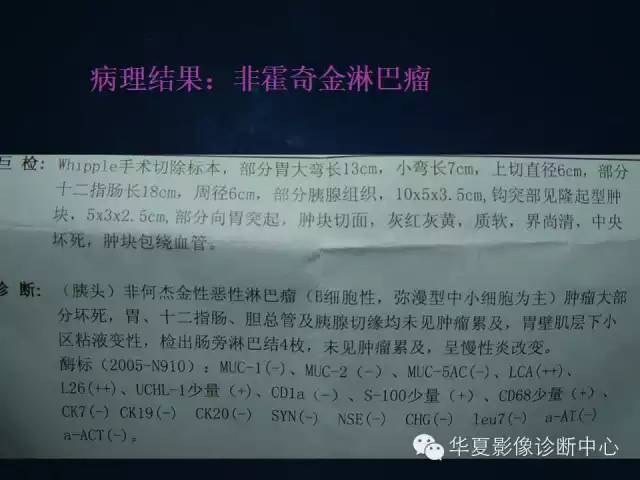 【病例】胰腺原发性恶性淋巴瘤1例CT影像表现与鉴别