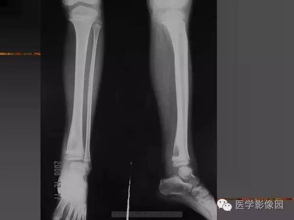 【病例】浆细胞性骨髓炎1例X线及CT影像表现