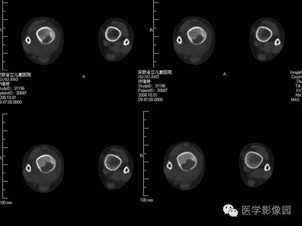 【病例】浆细胞性骨髓炎1例X线及CT影像表现