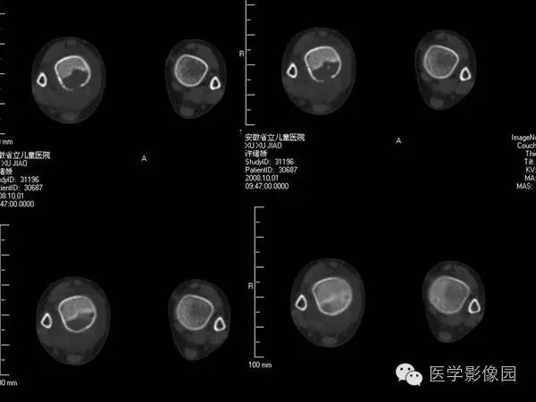 【病例】浆细胞性骨髓炎1例X线及CT影像表现