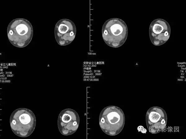 【病例】浆细胞性骨髓炎1例X线及CT影像表现