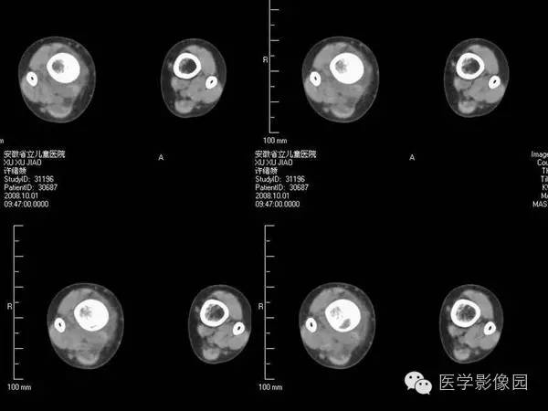 【病例】浆细胞性骨髓炎1例X线及CT影像表现