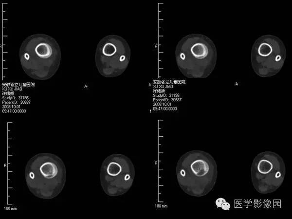 【病例】浆细胞性骨髓炎1例X线及CT影像表现