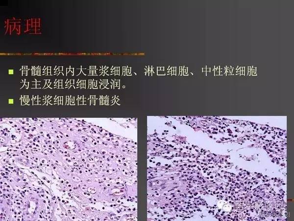 【病例】浆细胞性骨髓炎1例X线及CT影像表现
