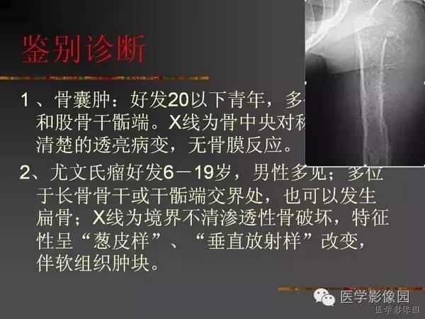 【病例】浆细胞性骨髓炎1例X线及CT影像表现