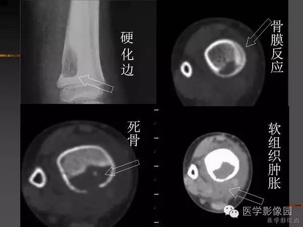 【病例】浆细胞性骨髓炎1例X线及CT影像表现