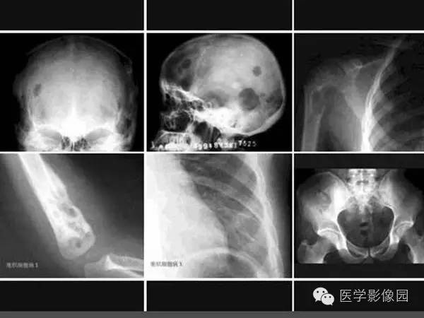 【病例】浆细胞性骨髓炎1例X线及CT影像表现