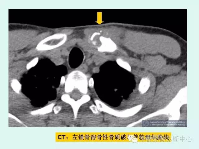 【病例】锁骨结核一例CT影像表现