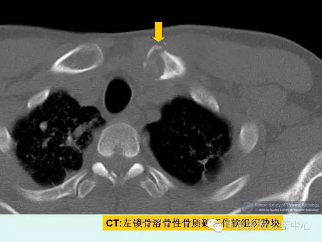 【病例】锁骨结核一例CT影像表现
