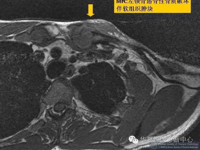 【病例】锁骨结核一例CT影像表现