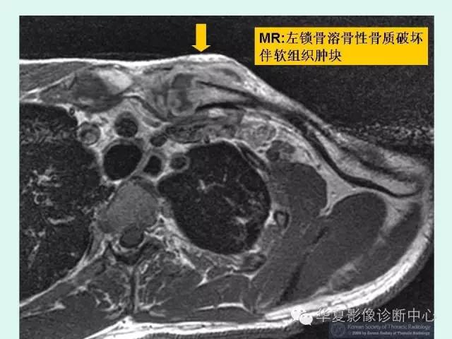 【病例】锁骨结核一例CT影像表现