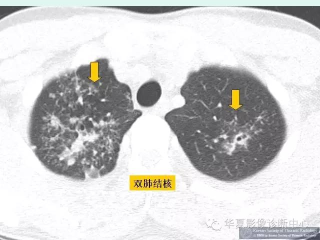 【病例】锁骨结核一例CT影像表现