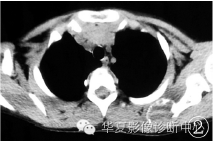 【病例】肩胛骨动脉瘤样骨囊肿1例X线CT及MR影像表现 【病例】肩胛骨动脉瘤样骨囊肿1例X线CT及MR影像表现