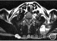 【病例】肩胛骨动脉瘤样骨囊肿1例X线CT及MR影像表现 【病例】肩胛骨动脉瘤样骨囊肿1例X线CT及MR影像表现