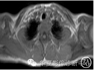 【病例】肩胛骨动脉瘤样骨囊肿1例X线CT及MR影像表现 【病例】肩胛骨动脉瘤样骨囊肿1例X线CT及MR影像表现