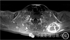【病例】肩胛骨动脉瘤样骨囊肿1例X线CT及MR影像表现 【病例】肩胛骨动脉瘤样骨囊肿1例X线CT及MR影像表现