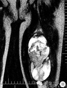 【病例】左大腿血管外皮肉瘤1例MR影像表现