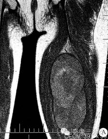【病例】左大腿血管外皮肉瘤1例MR影像表现
