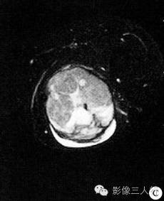 【病例】左大腿血管外皮肉瘤1例MR影像表现