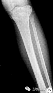 【病例】左胫骨弥漫性非霍奇金淋巴瘤1例X线MR影像表现