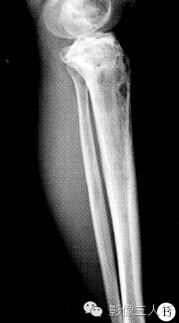 【病例】左胫骨弥漫性非霍奇金淋巴瘤1例X线MR影像表现