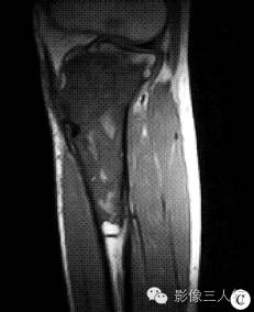 【病例】左胫骨弥漫性非霍奇金淋巴瘤1例X线MR影像表现