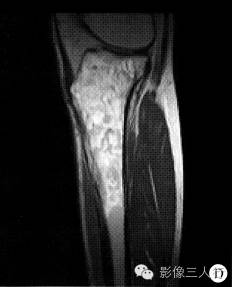 【病例】左胫骨弥漫性非霍奇金淋巴瘤1例X线MR影像表现