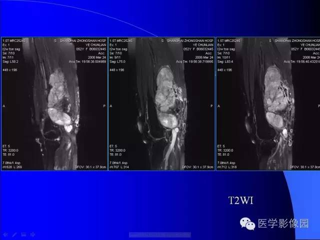 【病例】大腿恶性孤立性纤维瘤1例MR影像表现 【病例】大腿恶性孤立性纤维瘤1例MR影像表现